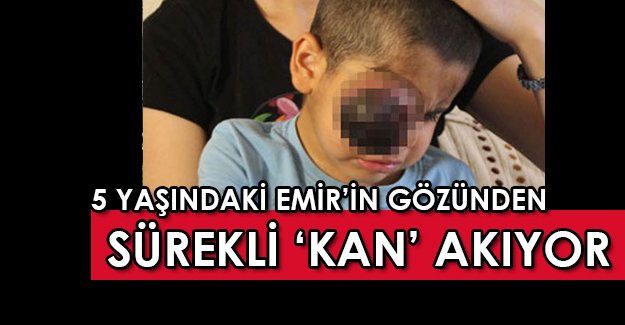 5 yaşındaki Emir'in gözünden sürekli kan akıyor!